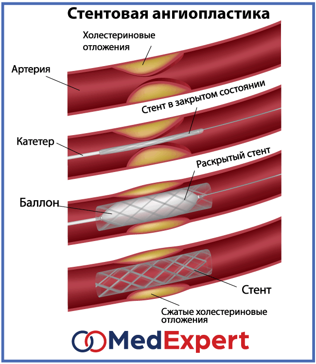 Лечение ИБС, ангиопластика и стентирование