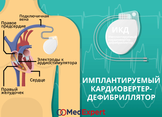 сердечная недостаточность лечение ИКД