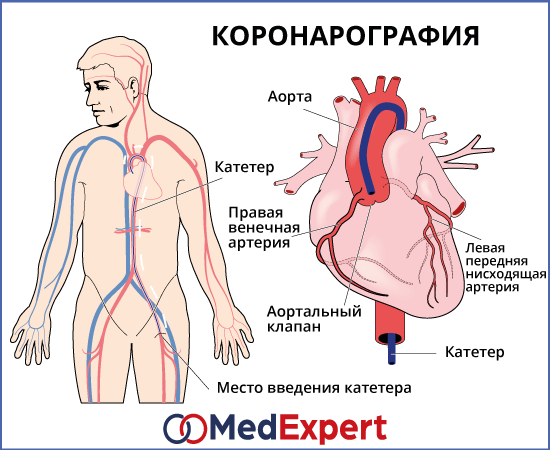 Опухоль сердца; Симптомы опухолей сердца; Лечение опухолей сердца