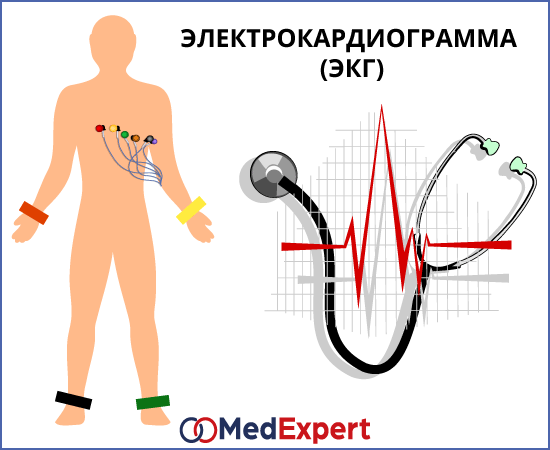 Тромбоэмболия легочной артерии; закупорка легочной артерии; Лечение тромбоэмболии легочной артерии