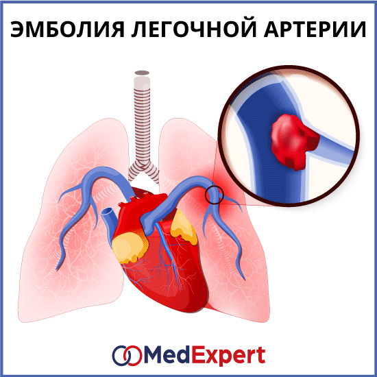 Тромбоэмболия легочной артерии; закупорка легочной артерии; Лечение тромбоэмболии легочной артерии