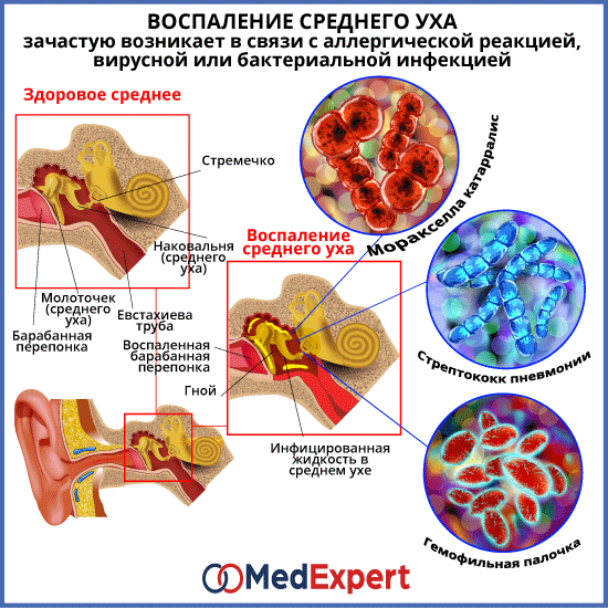 Отит среднего уха; Симптомы воспаления среднего уха; Лечение отита среднего уха