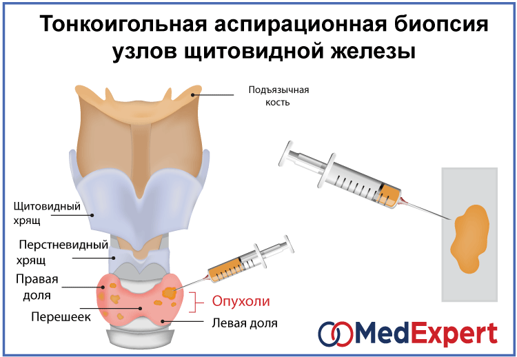 узловой зоб; Симптомы зоба щитовидной железы; Лечение узлового зоба; диагностика узлового зоба ТАБ