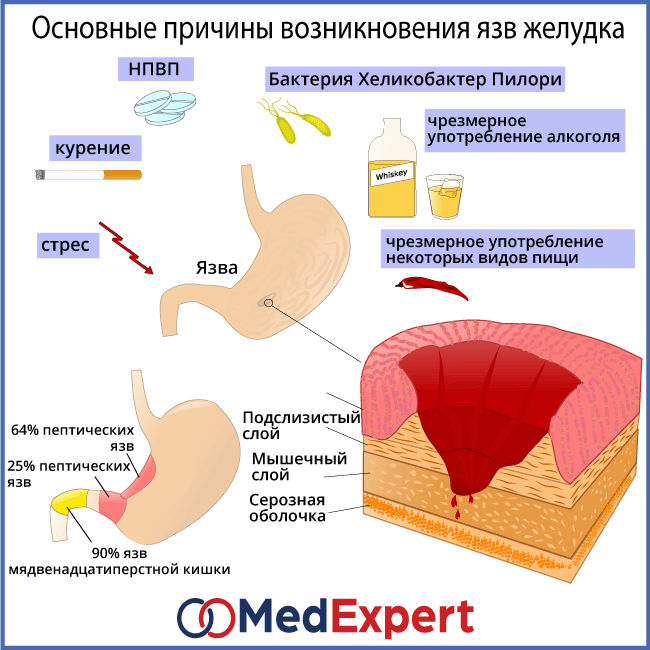 язва двенадцатиперстной кишки; Причины язвы двенадцатиперстной кишки; Лечение язвы двенадцатиперстной кишки