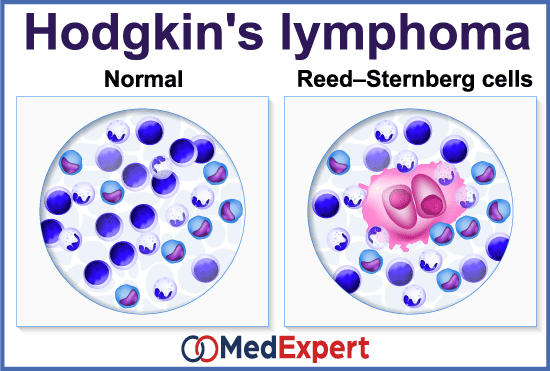 lymphoma causes and definition