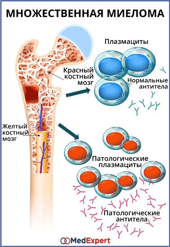 миелома прогноз, причины и лечение