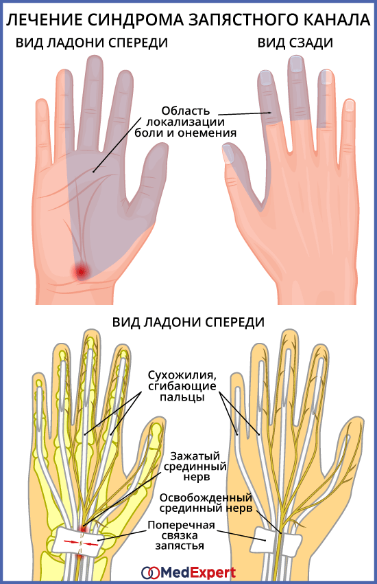 синдром запястного канала лечение