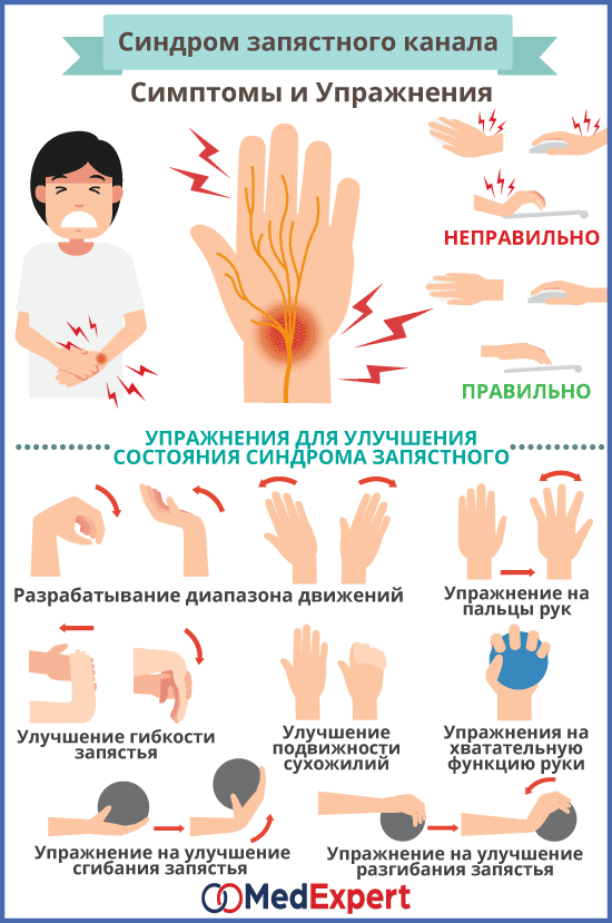 синдром запястного канала симптомы и упражнения