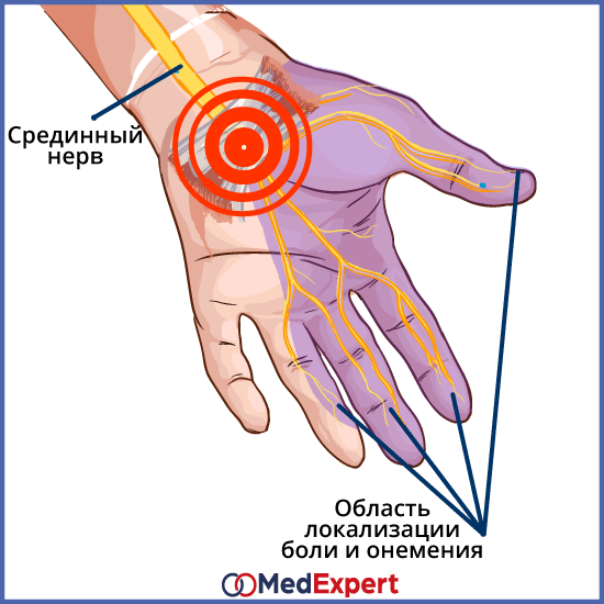 синдром запястного канала симптомы и лечение