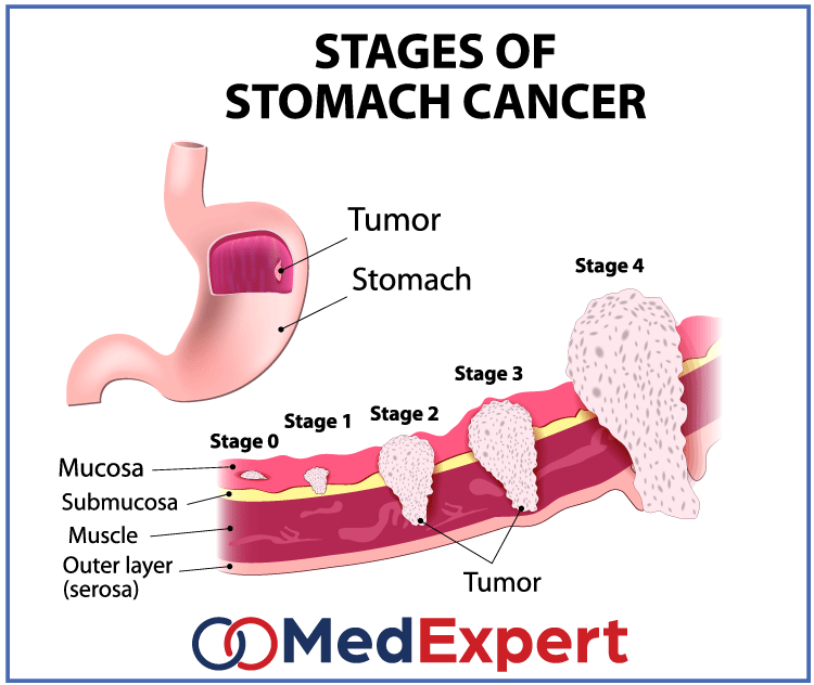 stomach cancer; stomach cancer symptoms; Stomach cancer treatment; Trastuzumab