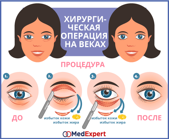 лечение птоза блефаропластика