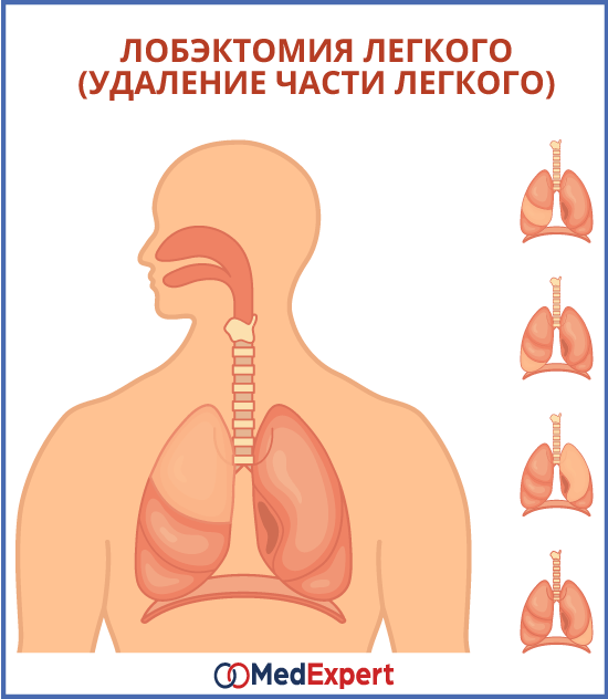 хирургическое лечение рака легкого, лобэктомия