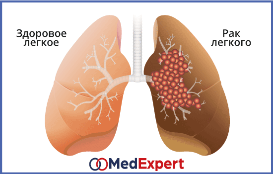 рак легкого лечение и прогноз