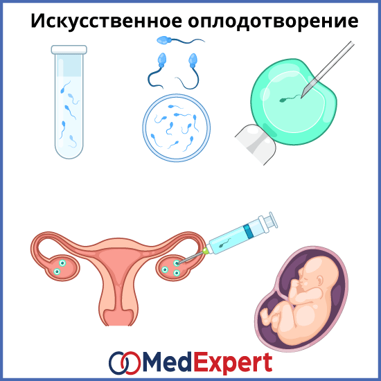 эко экстракорпоральное оплодотворение