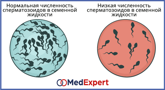 мужское бесплодие симптомы и виды