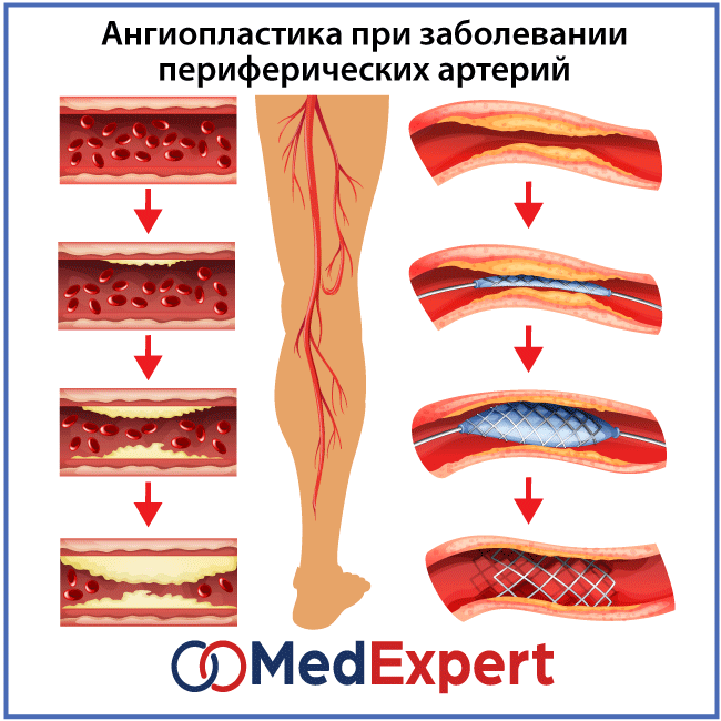 болезнь периферических сосудов лечение ангиопластика и стентирование