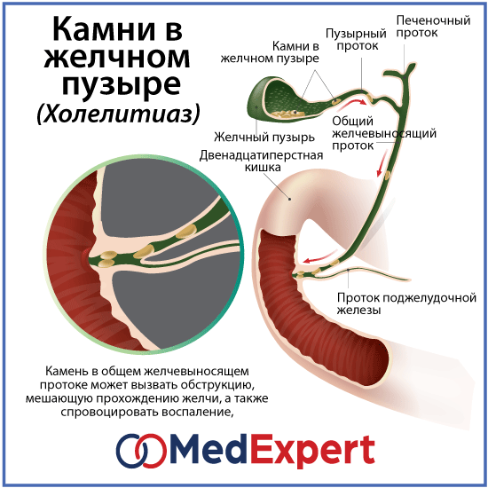 Удаляют ли желчный. Конкремент общего желчного протока. Камень из протока желчного пузыря. Камни в печеночных желчных протоках. Конкремент пузырного протока.