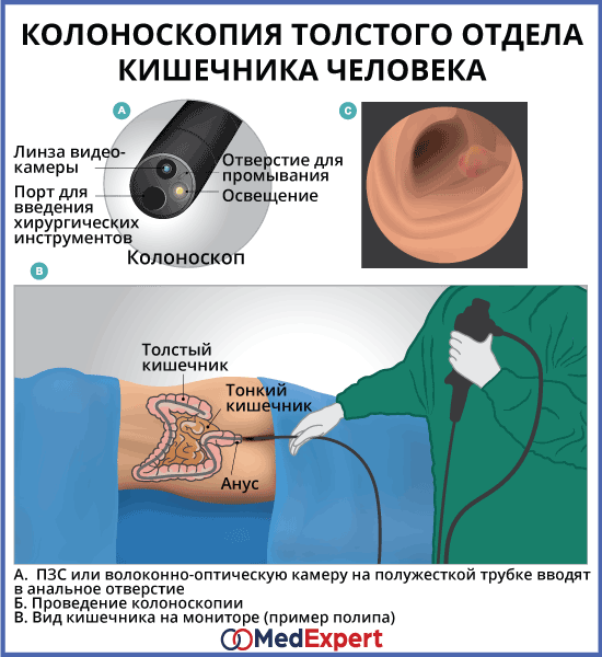 Как делается колоноскопия картинки