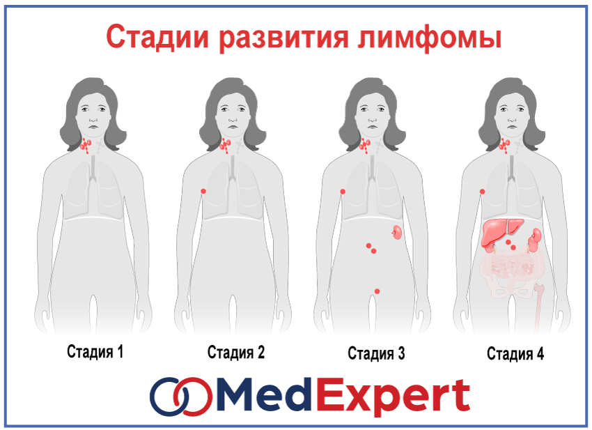 Стадии лимфомы