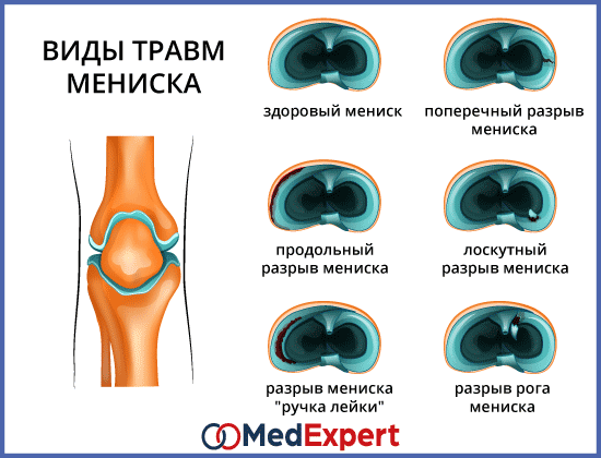 Симптомы повреждения мениска. Мениск разрыв мениска симптомы. Типы разрывов мениска коленного сустава. Разрывы мениска коленного сустава классификация. Симптомы повреждения менисков.