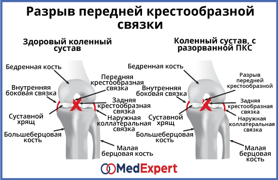 Растяжение связок коленного сустава карта вызова смп