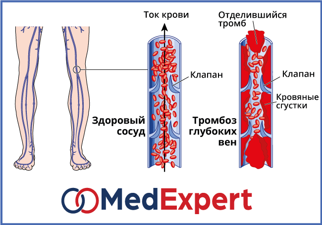 Венозный тромбоз факторы